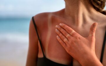 Como tratar e prevenir queimaduras solares na praia